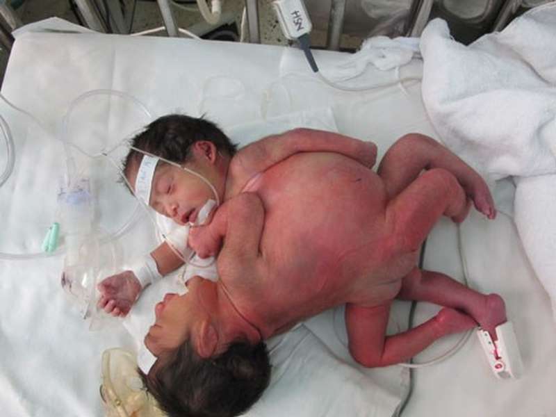 Dính bụng - Hình ảnh minh họa